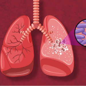 Tuberculosis and symptoms of tuberculosis